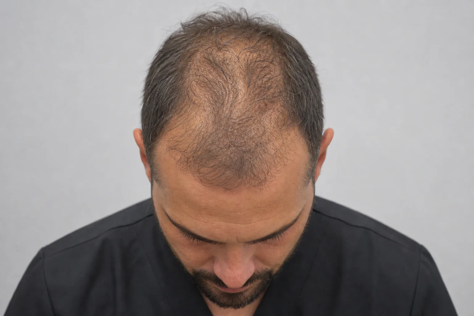 Наблюдение после пересадки волос в Just Clinic Istanbul с естественным результатом