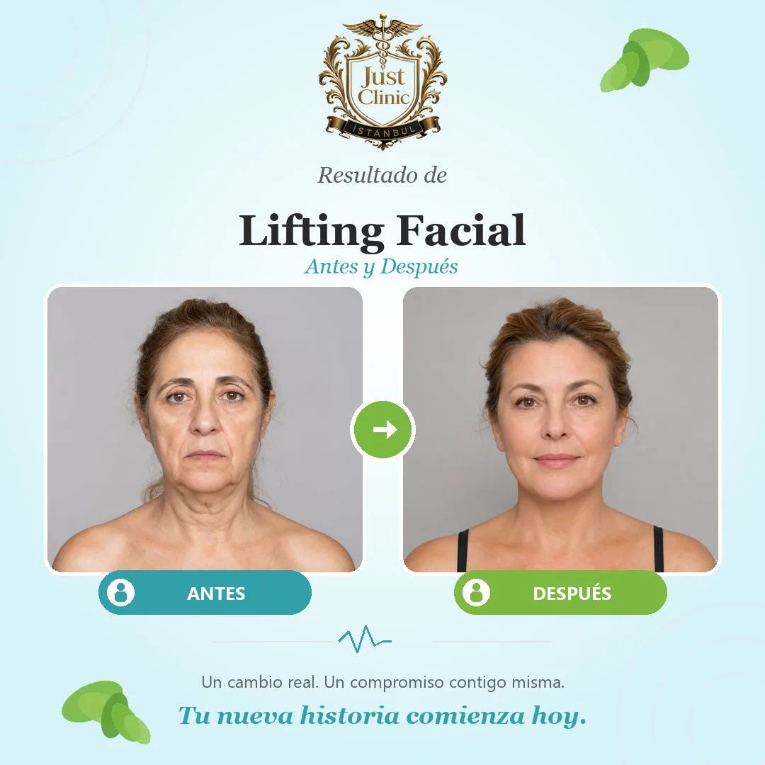 Real facelift case in Turkey with a firm, balanced facial contour