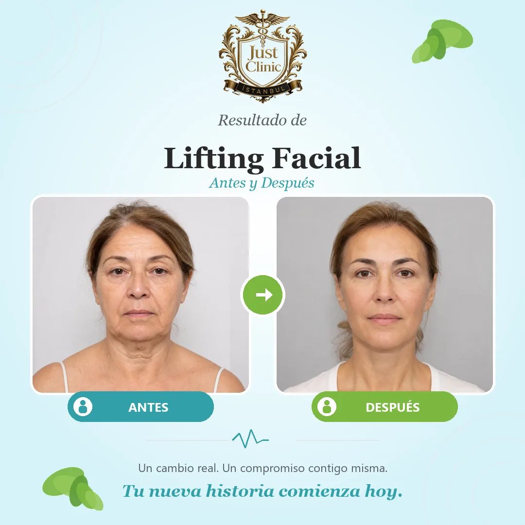 Final facelift result in Istanbul with a fresh, proportionate face