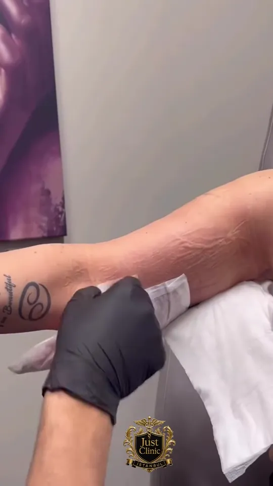 Patient showing a result after cosmetic surgery in Istanbul